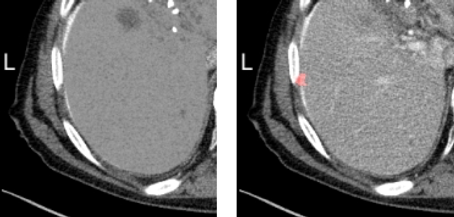 Liver CT registration for CT-guided ablation