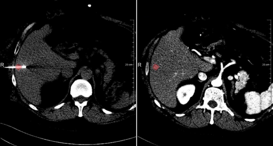 Liver CT registration for CT-guided ablation
