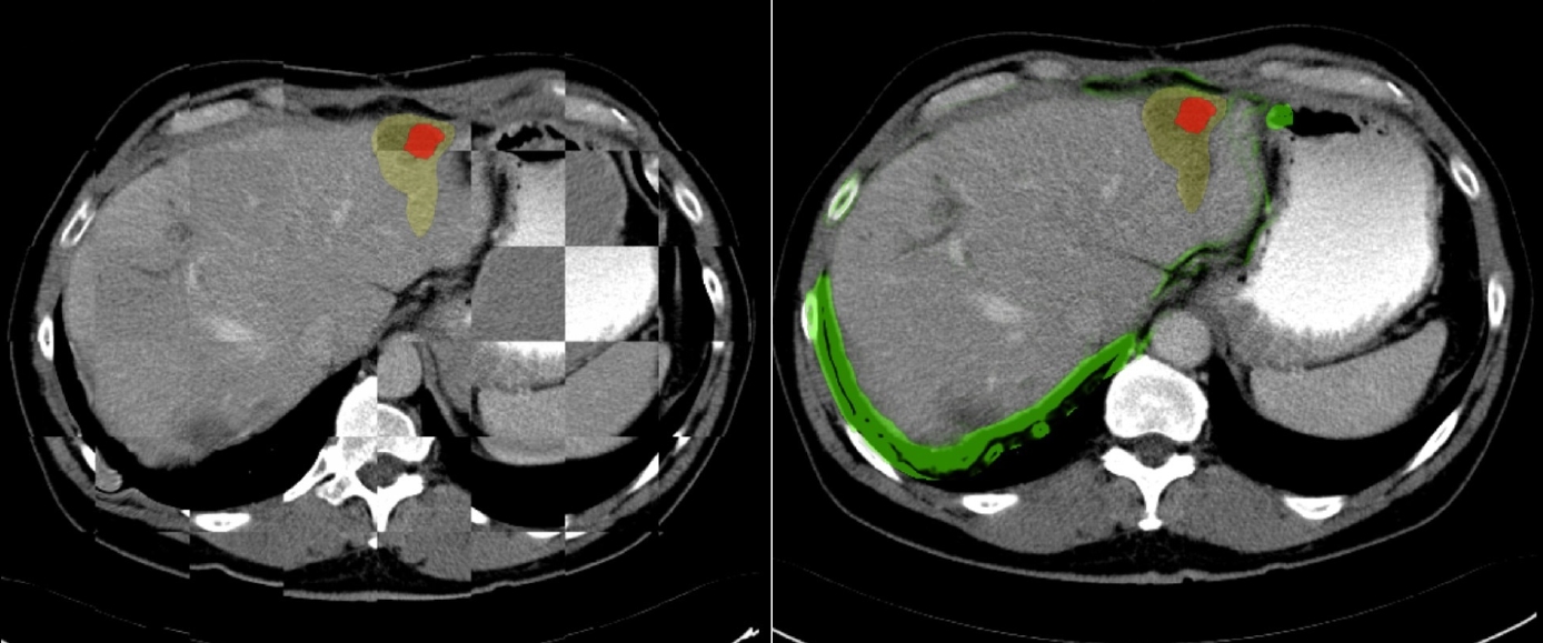 CT-guided ablation of liver lesions