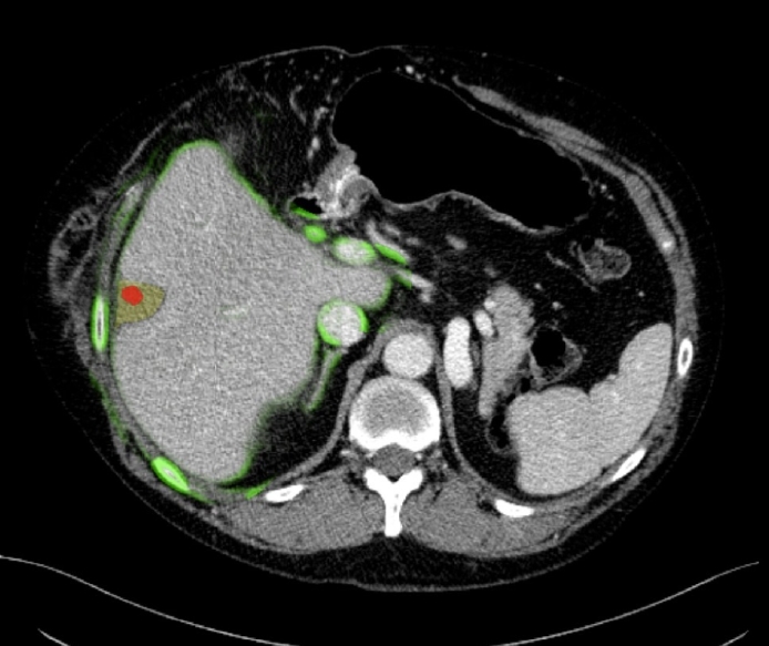 Pre- and post-interventional liver CT registration