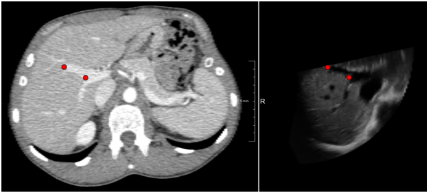 Multiple-correlation similarity for block-matching based fast CT to ultrasound registration in liver interventions