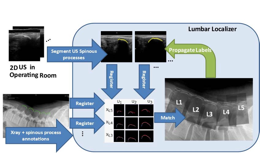 Lumbar Localizer