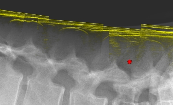 Lumbar Localizer