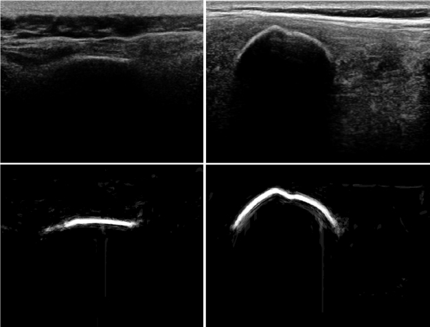 2D Ultrasound Bone Segmentation