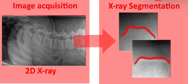 2D Lumbar Spine X-ray Bone Segmentation
